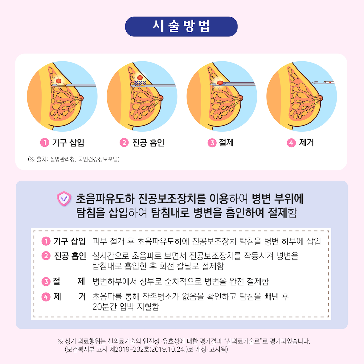 초음파 유도하의 진공보조장치를 이용한 유방 양성병변 절제술(맘모톰) 이미지6