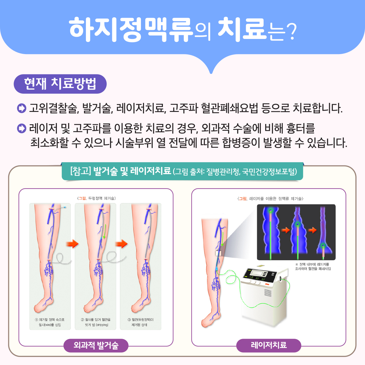 시아노아크릴레이트를 이용한 복재정맥 폐색술 이미지3