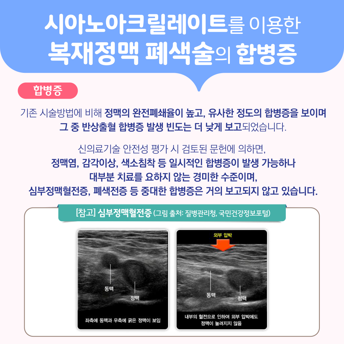 시아노아크릴레이트를 이용한 복재정맥 폐색술 이미지5